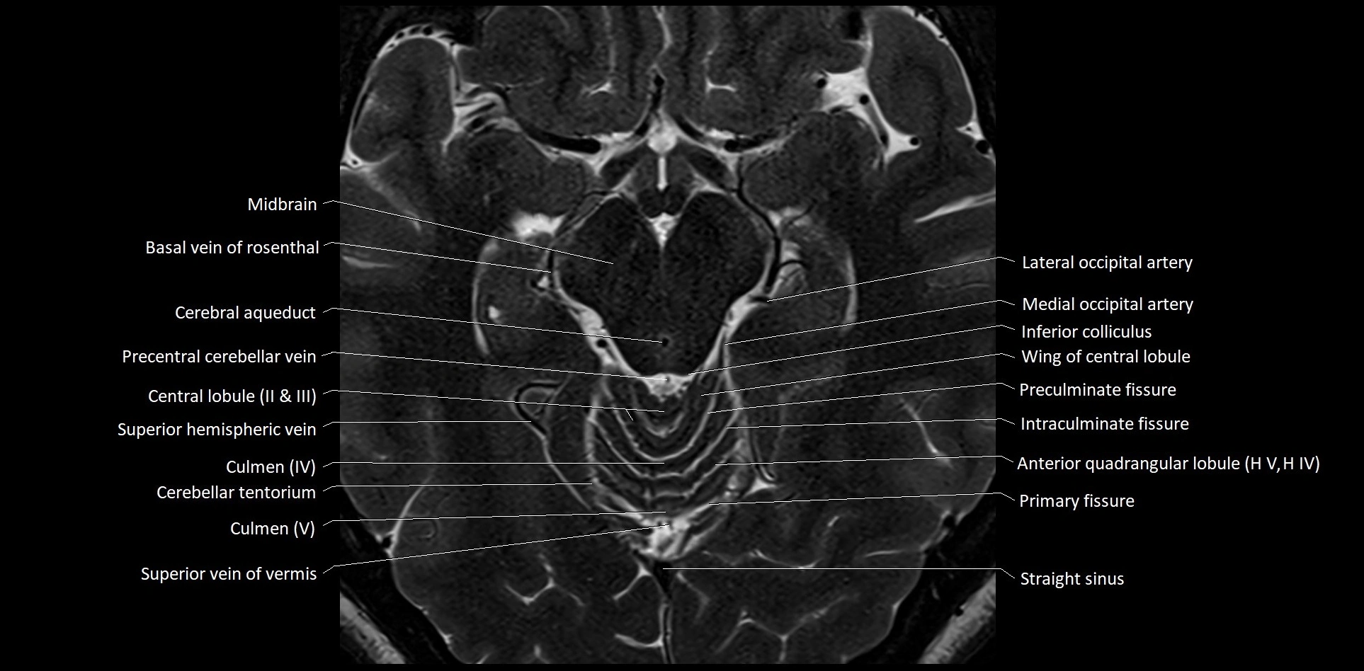 MRI Cerebellar anatomy High-resolution labelled 3T MRI image 25.webp